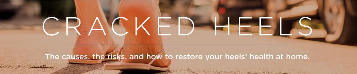 Cracked heels banner showing feet walking in sandals, promoting information on causes, risks and home treatments for dry, cracked or damaged heels, suitable for foot-care and skincare advice.